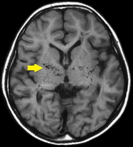 moyamoya disease: a rare brain blood vessel disorder where the main arteries supplying the brain gradually narrow or...