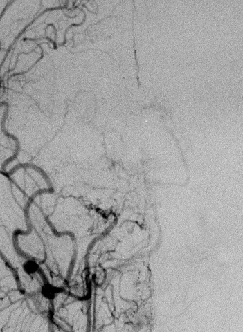 moyamoya: a disease in which certain arteries in the brain are constricted