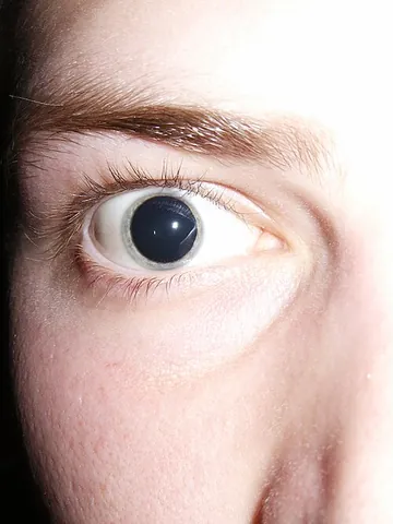 mydriasis: the condition of having abnormally large and dilated pupils due to illness or narcotics,...