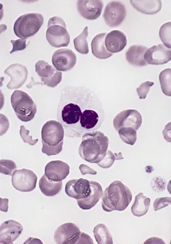 myelodysplastic syndrome: one of a group of hematological conditions that cause ineffective production (or dysplasia) of all...
