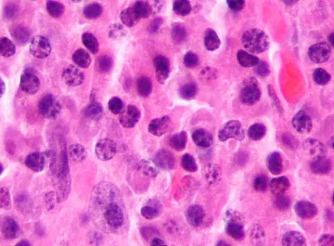 myeloma: a malignant tumour arising from cells of the bone marrow, specifically plasma cells