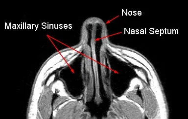 nasal septum: a bony and cartilaginous partition in the nose, separating the left and right airways in the nose...