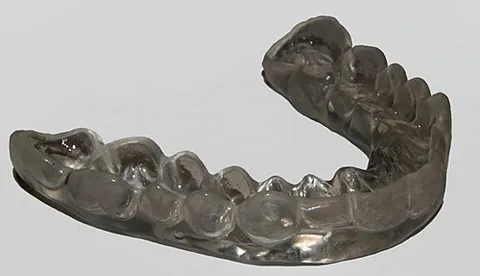 occlusal guard: a removable device worn between the upper and lower teeth to prevent their meeting