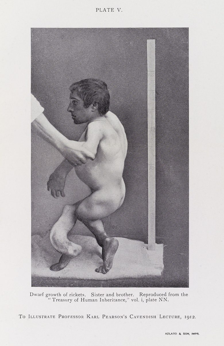 rachitic: of or pertaining to, or affected by, rickets (“a disorder of infancy and early childhood due to a...