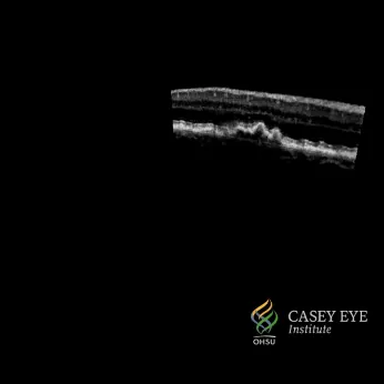 optical coherence tomography: a noninvasive imaging test that uses light waves to capture high-resolution, cross-sectional...