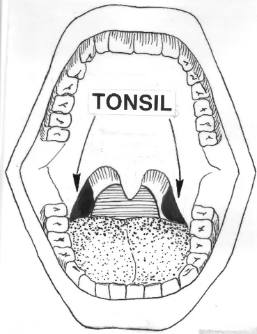 palatine tonsil: one of the two tonsils that can be seen on the left and right sides at the back of the throat