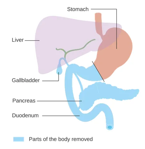 pancreatectomy: a surgical operation in which part or all of the pancreas is removed, usually to treat pancreatic...