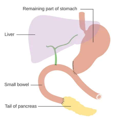pancreaticoduodenectomy: a major surgical procedure involving removal of the head of the pancreas, the duodenum, and often...