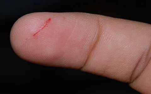 paper cut: a wound caused by a piece of paper or any thin, sharp material which can slice through a person's...