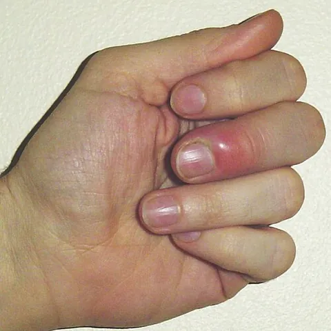 paronychia: an infection of the cuticle of a fingernail or toenail