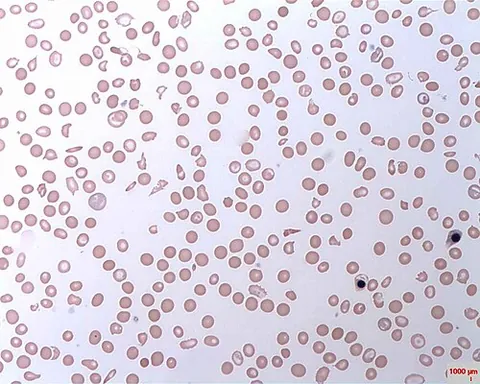 paroxysmal nocturnal hemoglobinuria: a rare, acquired blood disorder in which a mutation in the PIGA gene causes red blood cells to lack...