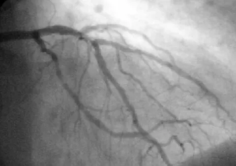 percutaneous coronary intervention: a minimally invasive procedure that opens blocked or narrowed coronary arteries to restore blood...
