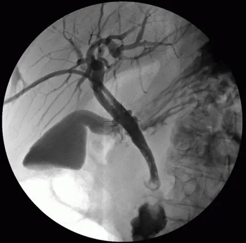 percutaneous transhepatic cholangiography: an invasive imaging procedure in which a needle is inserted through the skin and liver into a bile...