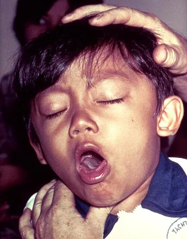 pertussis: whooping cough