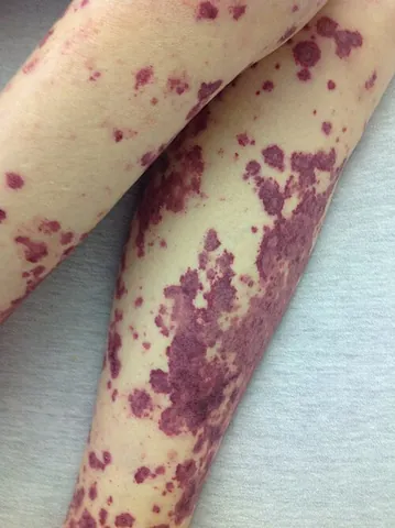 petechia: a small spot, especially on an organ, caused by bleeding underneath the skin