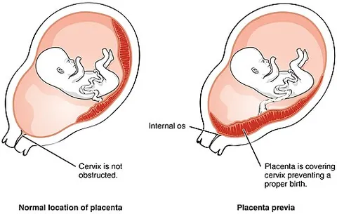 placenta praevia: a complication of pregnancy in which the placenta is inserted partially or completely in the lower...