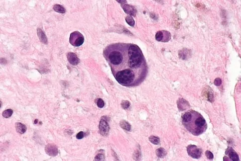 plasma cell: a form of B cell that produces antibodies after having reacted with its specific antigen in...