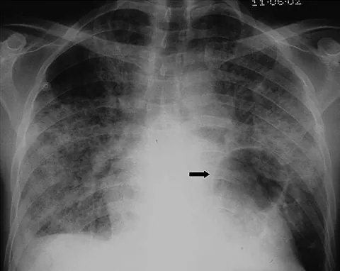 pneumocystis pneumonia: a form of pneumonia caused by the yeast-like fungus Pneumocystis jirovecii