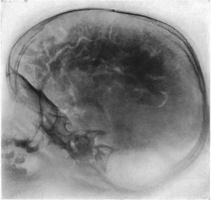 pneumoencephalography: a former medical procedure in which most of the cerebrospinal fluid was drained from around the...