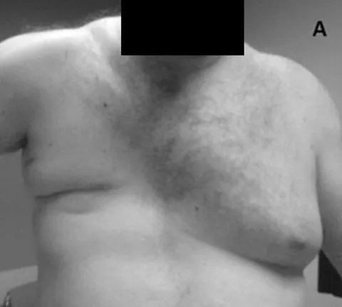 poland syndrome: a rare birth defect characterized by underdevelopment or absence of the pectoralis on one side of...