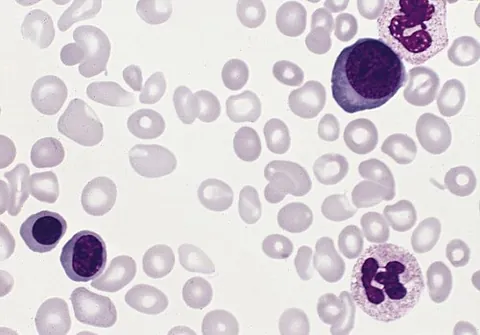 polycythemia vera: a neoplasm of bone marrow in which too many red blood cells are produced, usually along with white...