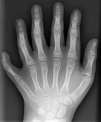 polydactyly: a congenital condition in which a person or animal has more than the usual number of digits...