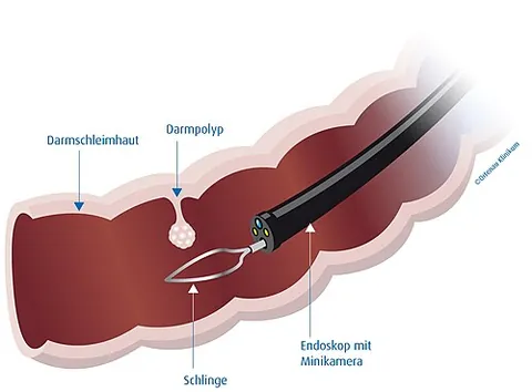polypectomy: the surgical removal of a polyp, typically performed to diagnose, treat, or prevent conditions such...