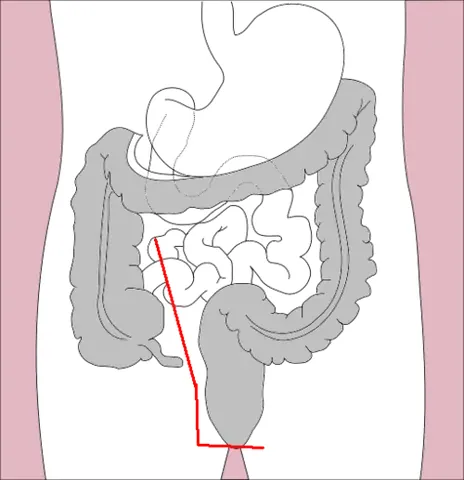 proctocolectomy: a surgical procedure involving complete excision of the colon and rectum, typically performed to...
