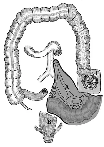 proctosigmoidectomy: the surgical removal of the rectum and sigmoid colon to treat serious disease in the lower large...