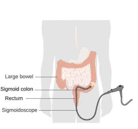 proctosigmoidoscopy: an endoscopic examination of the rectum and sigmoid colon using a flexible or rigid scope
