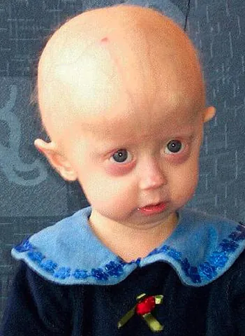 progeria: an extremely rare genetic condition wherein symptoms resembling aspects of aging are manifested at...