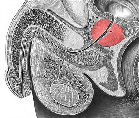 prostate gland: a gland in male mammals surrounding the urethra just below the urinary bladder that controls the...