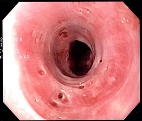 pseudodiverticulosis: a condition characterized by the presence of pseudodiverticula (false diverticula that do not...