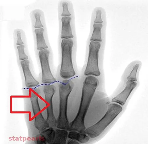 pseudohypoparathyroidism: a rare inherited disorder where the body does not respond properly to parathyroid hormone, causing...
