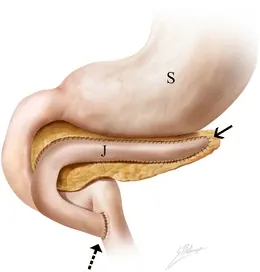 puestow procedure: a surgical procedure for treating chronic pancreatitis in which the main pancreatic duct is opened...