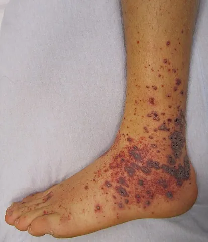 purpura: the appearance of red or purple discolorations on the skin that do not blanch when pressure is...