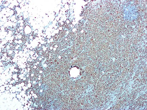 pyelonephritis: an ascending urinary tract infection of the renal pelvis
