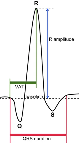 qrs complex: a series of graphical deflections on a typical electrocardiogram that represents the electrical...