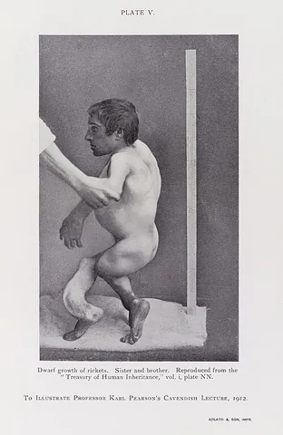 rachitic: of or pertaining to, or affected by, rickets (“a disorder of infancy and early childhood due to a...