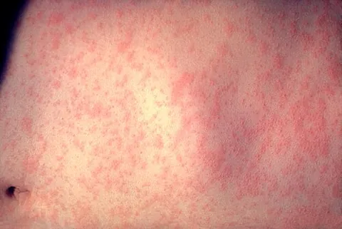 red measles: measles, rubeola