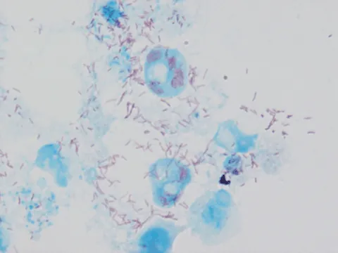 rickettsia: any of a group of gram-negative bacteria, of the genus Rickettsia, carried as parasites by ticks,...
