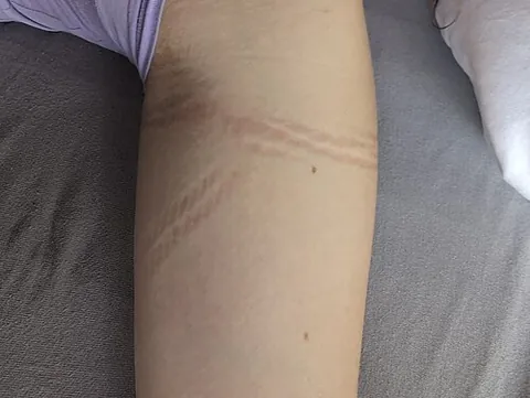 rope kiss: a temporary imprint or mark left on the skin by a rope