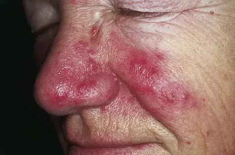 rosacea: a chronic condition characterized by redness of the face