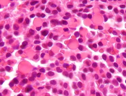russell body: a PAS+, eosinophilic, cytoplasmic immunoglobulin-containing inclusion consisting of distended...