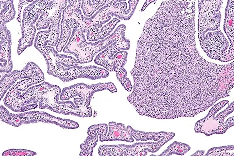salpingitis: inflammation of one or both fallopian tubes, usually caused by a bacterial infection that spreads...