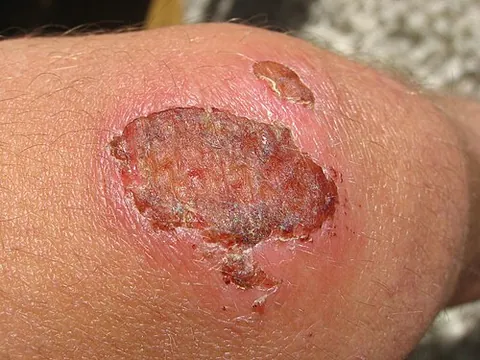 scab: an incrustation over a sore, wound, vesicle, or pustule, formed during healing