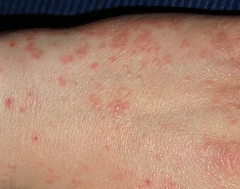 scabies: an infestation of parasitic mites, Sarcoptes scabiei, causing intense itching caused by the mites...