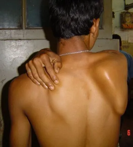 scapular winging: a condition where the shoulder blades stick out from the back instead of lying flat against the ribs