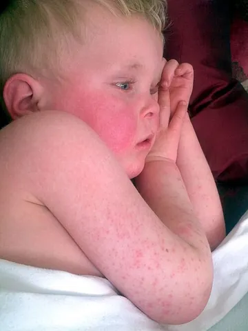 scarlet fever: a streptococcal infection, mainly occurring among children, and characterized by a red skin rash,...