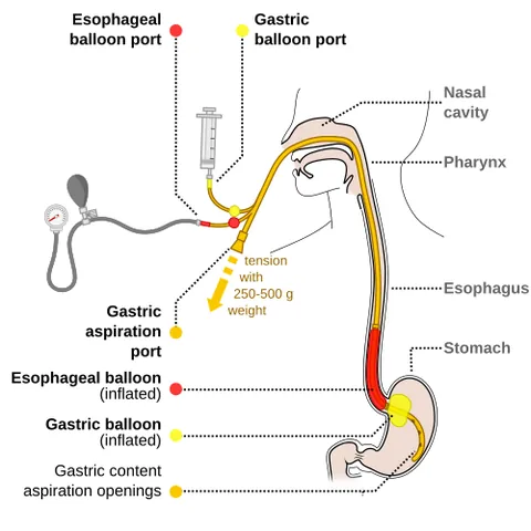 sengstaken-blakemore tube: a medical device inserted through the nose or mouth and used occasionally in the management of...